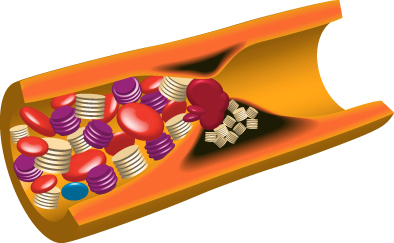 血管が狭くなり詰まる