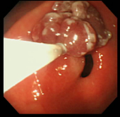 ポリープ症例3