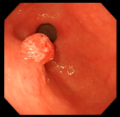 ポリープ症例6