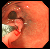 ポリープ症例10