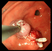 ポリープ症例12