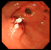 ポリープ症例13